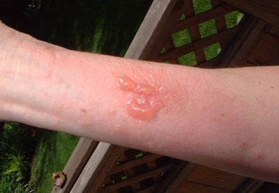 Rash Pictures - most from contact with poison ivy, poison ...