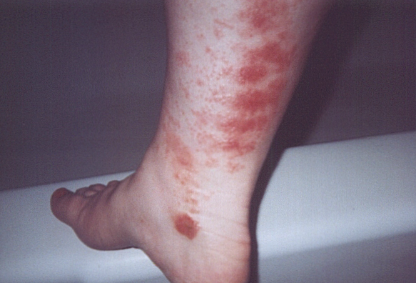 poison ivy rashes. poison ivy rash pics. poison